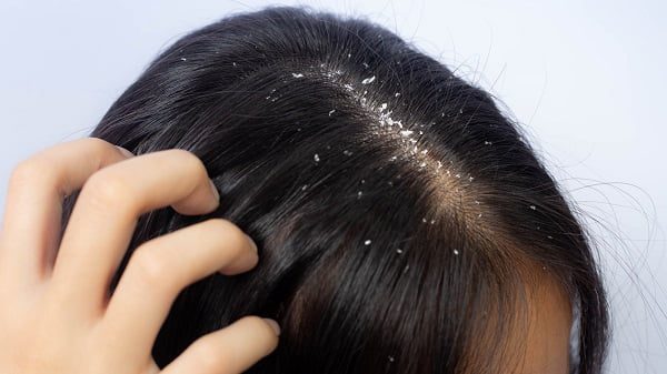 dandruff on hair, Dangers of Sleeping with Wet Hair