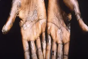 Monkeypox diagnosed in Belgium