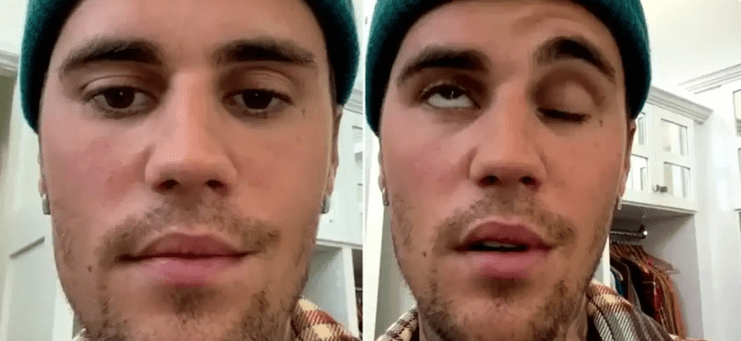 Justin Bieber has a paralyzed face what is Ramsay-Hunt syndrome