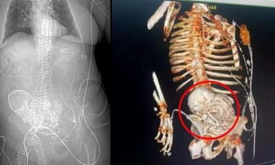 Elderly woman is identified with calcified fetus for more than