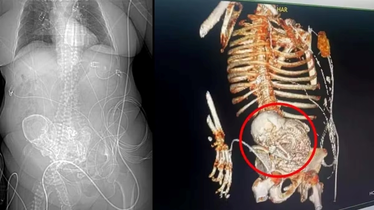 Elderly woman is identified with calcified fetus for more than