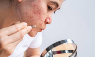 Discover what causes acne and learn how to prevent and