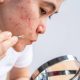 Discover what causes acne and learn how to prevent and